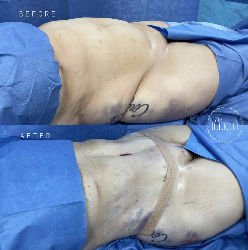 Tummy Tuck / Abdominoplasty, Plastic Surgery in Tijuana