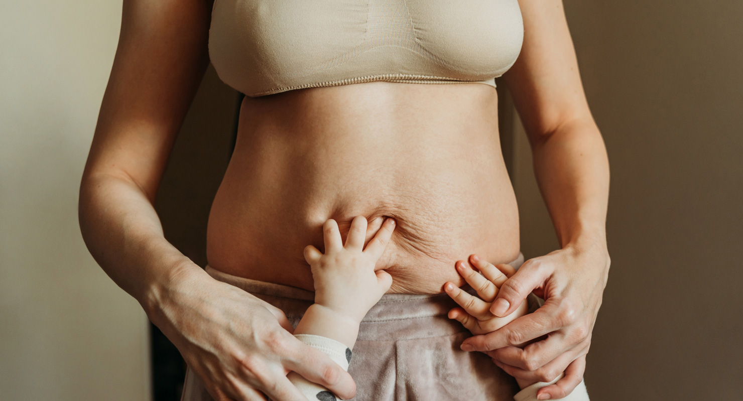 Transform your body with a mommy makeover surgery in Tijuana, Mexico